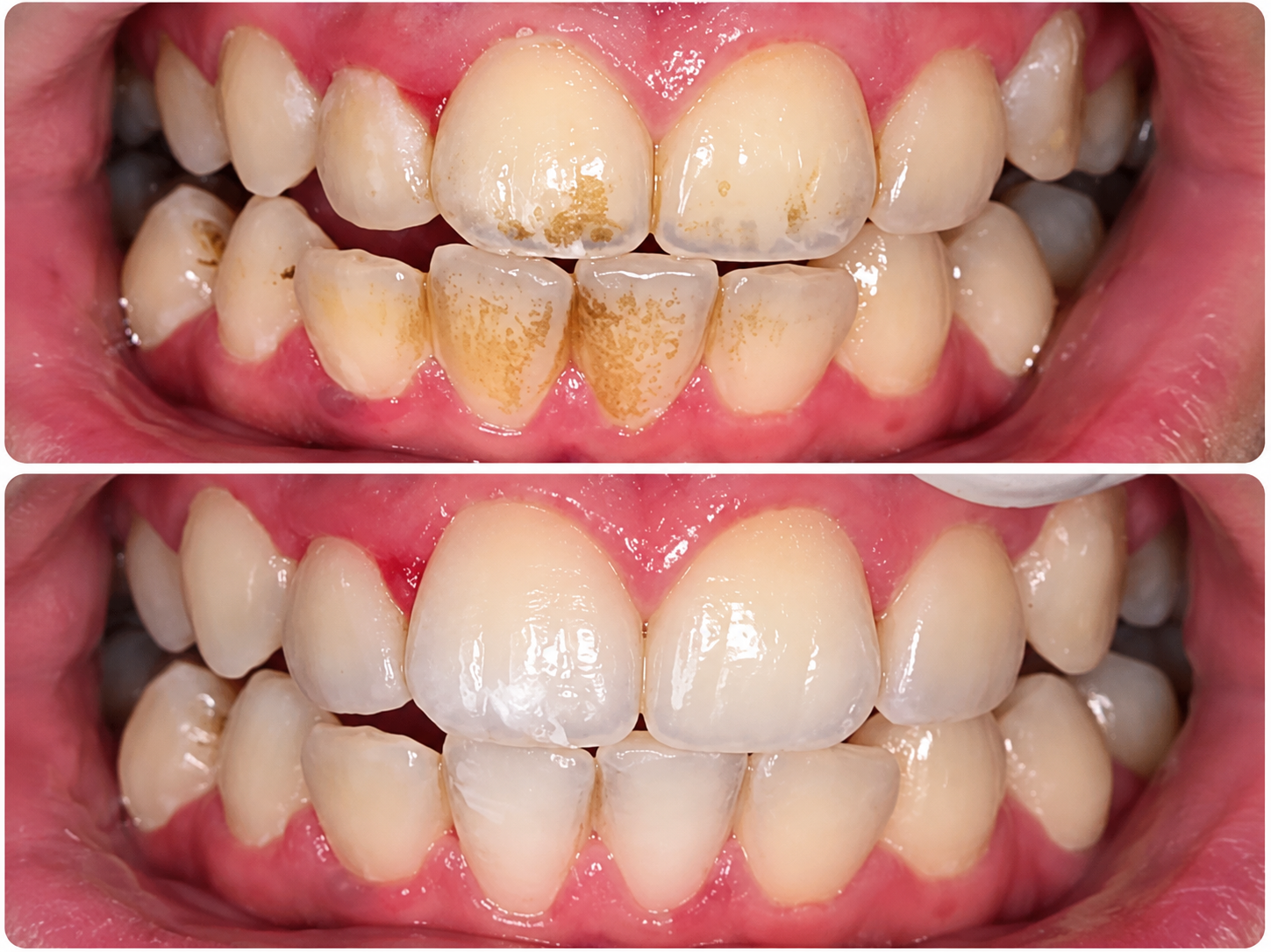 Real Patient Smile Makeover Before and After